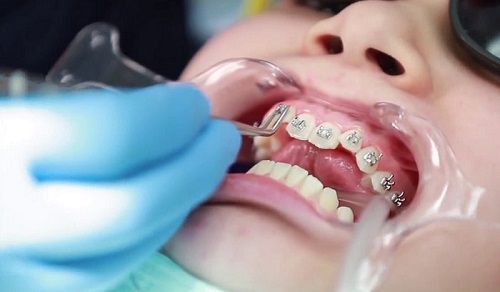 Niềng răng người lớn giá bao nhiêu? Gợi ý mức chi phí cho bạn-4 Niềng răng người lớn giá bao nhiêu? Gợi ý mức chi phí cho bạn-4