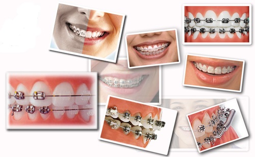 Tư vấn trường hợp - Niềng răng thưa có đau không?-3 Tư vấn trường hợp - Niềng răng thưa có đau không?-3
