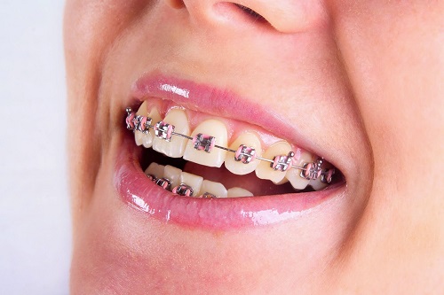 Các bước thực hiện niềng răng trả góp tphcm tại nha khoa-1 Các bước thực hiện niềng răng trả góp tphcm tại nha khoa-1