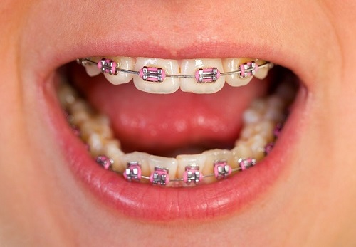 Các bước thực hiện niềng răng trả góp tphcm tại nha khoa-2