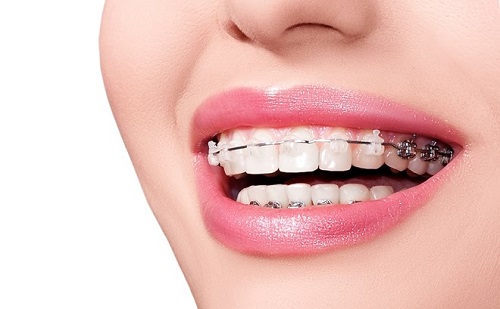 Các bước thực hiện niềng răng trả góp tphcm tại nha khoa-3 Các bước thực hiện niềng răng trả góp tphcm tại nha khoa-3