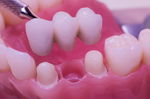 Trồng răng sứ có đau không? Kiến thức cần biết trước khi trồng răng 2
