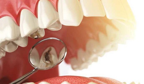 Bọc răng sứ có an toàn không? 3 lưu ý khi bọc răng sứ-2
