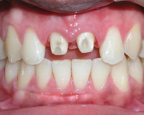Giải đáp tình trạng - Bọc răng sứ có bị rớt ra không?-2 Giải đáp tình trạng - Bọc răng sứ có bị rớt ra không?-2