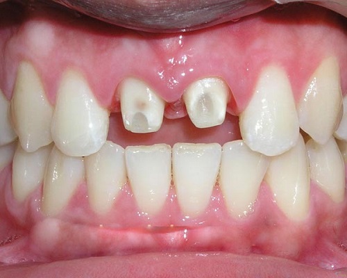 Bọc răng sứ có nguy hiểm không? Nha khoa tư vấn-2