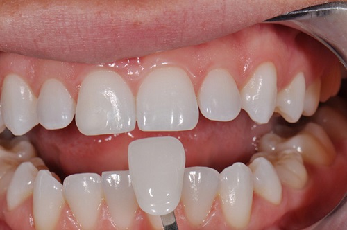 Bọc răng sứ giữ được bao lâu? Những điều cần tránh khi bọc răng sứ-2