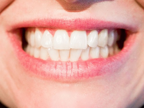 Bọc răng sứ giữ được bao lâu? Những điều cần tránh khi bọc răng sứ-4
