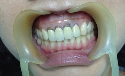 Bọc răng sứ kim loại có bền không? Duy trì độ bền bao lâu-2