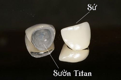 Bọc răng sứ kim loại có bền không? Duy trì độ bền bao lâu-3 Bọc răng sứ kim loại có bền không? Duy trì độ bền bao lâu-3