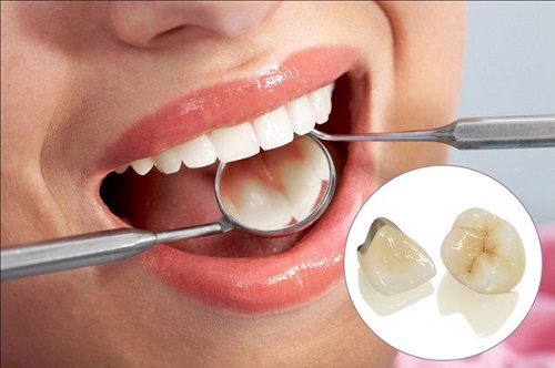 Bọc răng sứ kim loại có bền không? Duy trì độ bền bao lâu-4