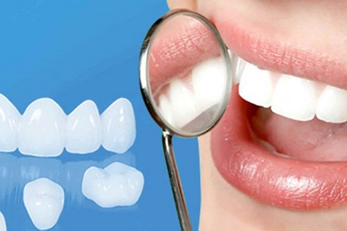 Bọc răng sứ veneer có tốt không? Tìm hiểu ngay-1