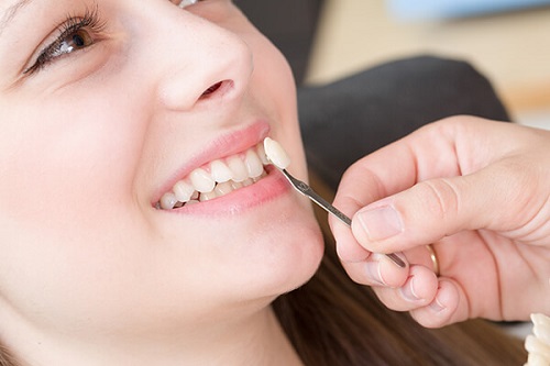 Dán răng sứ có bền không? Cần lưu ý gì khi dán răng sứ-2