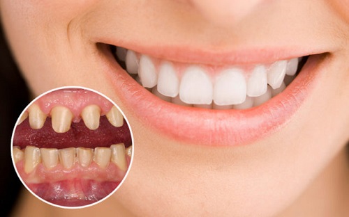 Hỏi đáp - Làm răng sứ có niềng răng được không?-1 Hỏi đáp - Làm răng sứ có niềng răng được không?-1