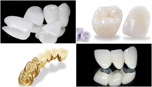 Làm răng sứ thẩm mỹ loại nào tốt? Gợi ý cách chọn lựa-2 Làm răng sứ thẩm mỹ loại nào tốt? Gợi ý cách chọn lựa-2
