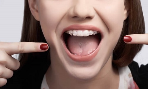Niềng răng hàm trên mất bao lâu? Khi nào nên niềng răng-1