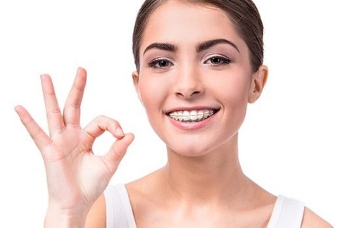 Niềng răng hàm trên mất bao lâu? Khi nào nên niềng răng-2
