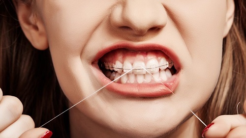 Niềng răng hàm trên mất bao lâu? Khi nào nên niềng răng-4