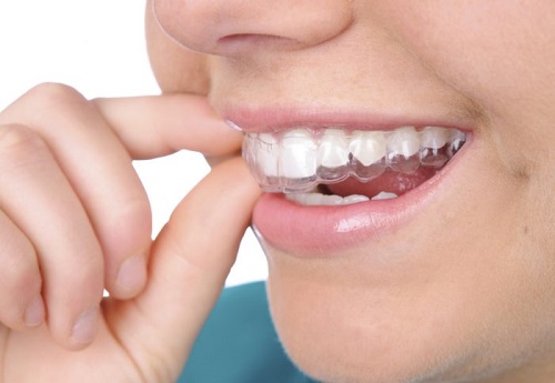 Tư vấn - Niềng răng trong suốt có phải nhổ răng không?-1 Tư vấn - Niềng răng trong suốt có phải nhổ răng không?-1