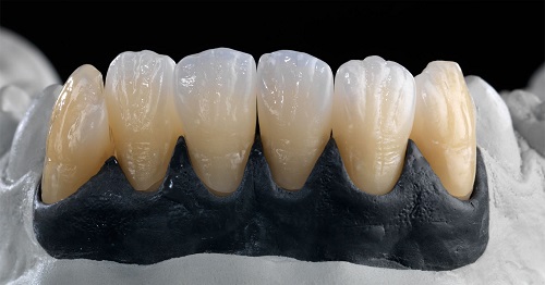 Răng sứ ceramill đỉnh cao công nghệ thẩm mỹ-1