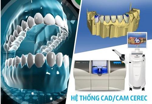 Răng sứ ceramill đỉnh cao công nghệ thẩm mỹ-2 Răng sứ ceramill đỉnh cao công nghệ thẩm mỹ-2