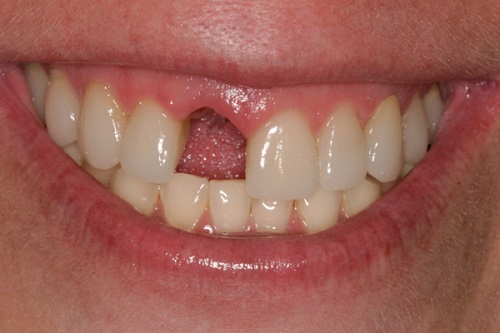 Trồng răng bằng cầu răng - Giải pháp tốt cho bạn 1