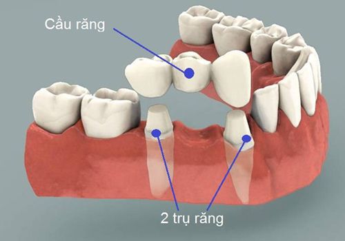 Trồng răng bằng cầu răng - Giải pháp tốt cho bạn 2