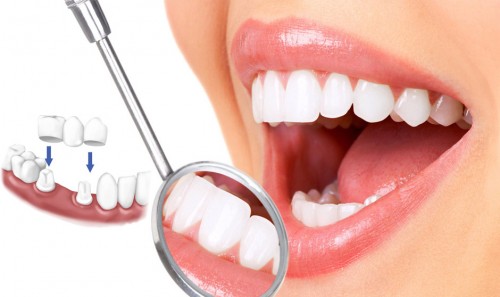 Trồng răng bằng cầu răng - Giải pháp tốt cho bạn 4 Trồng răng bằng cầu răng - Giải pháp tốt cho bạn 4