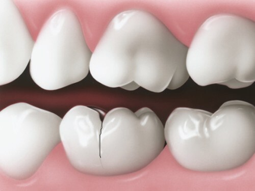 Trồng răng sứ có bị hôi miệng không? Cách xử lý dứt điểm-2