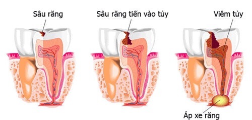 Trồng răng sứ có phải lấy tủy không? Vì sao?-1 Trồng răng sứ có phải lấy tủy không? Vì sao?-1