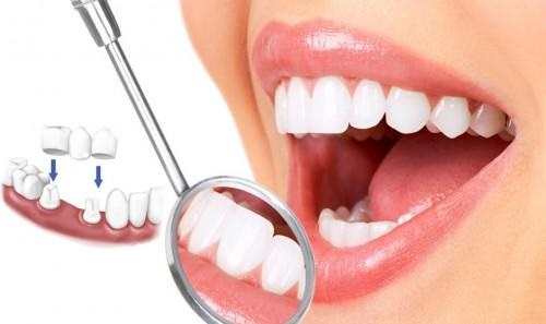 Trồng răng sứ có tháo ra được không? Nguyên nhân và cách xử lý-1
