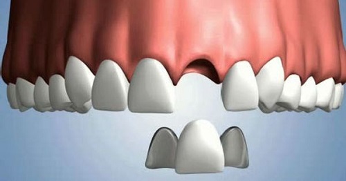 Trồng răng sứ có tháo ra được không? Nguyên nhân và cách xử lý-2