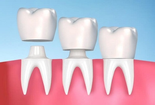 Trồng răng sứ có tháo ra được không? Nguyên nhân và cách xử lý-3