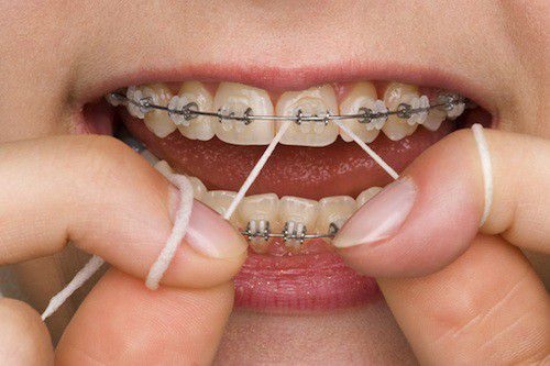 Niềng răng bao lâu thì nên có bầu? Lưu ý khi niềng răng-4