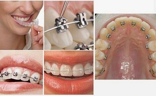 Niềng răng bị lòi chân răng phải xử lý ra sao?-3