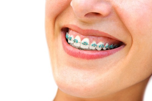 Niềng răng chữa cười hở lợi bạn có tin không? Tìm hiểu ngay-1