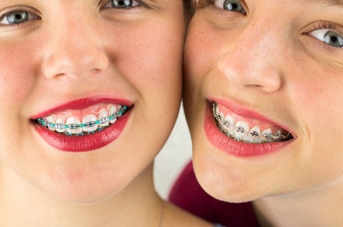 Niềng răng chữa cười hở lợi bạn có tin không? Tìm hiểu ngay-2