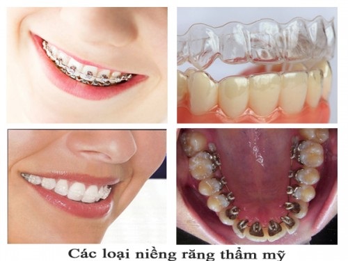 Niềng răng chữa cười hở lợi bạn có tin không? Tìm hiểu ngay-4 Niềng răng chữa cười hở lợi bạn có tin không? Tìm hiểu ngay-4