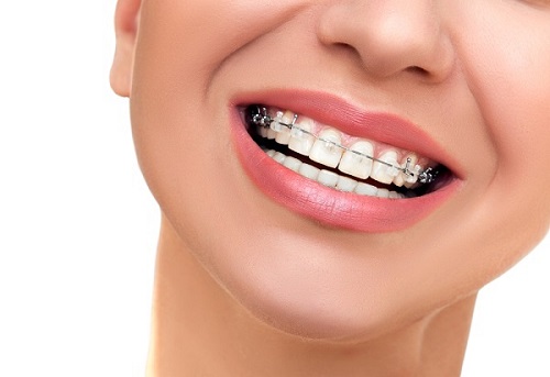 Niềng răng gây hôi miệng - Cách chăm sóc răng hiệu quả-2