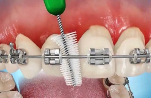 Niềng răng gây hôi miệng - Cách chăm sóc răng hiệu quả-4 Niềng răng gây hôi miệng - Cách chăm sóc răng hiệu quả-4