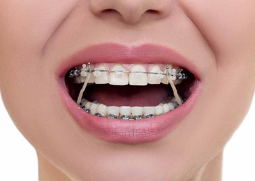 Niềng răng giai đoạn nào đau nhất? Tư vấn từ nha khoa-1