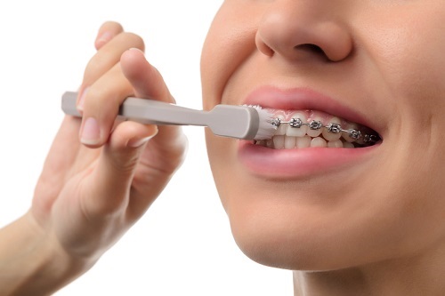 Niềng răng giai đoạn nào đau nhất? Tư vấn từ nha khoa-4