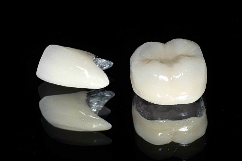 Răng sứ có bị xuống màu không? Tìm hiểu về các vật liệu làm răng sứ-3 Răng sứ có bị xuống màu không? Tìm hiểu về các vật liệu làm răng sứ-3
