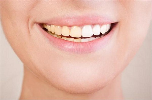 Răng sứ có bị xuống màu không? Tìm hiểu về các vật liệu làm răng sứ-4