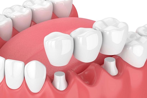 Trồng răng có ảnh hưởng gì không? Tìm hiểu ngay 2