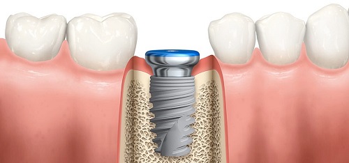 Trồng răng có ảnh hưởng gì không? Tìm hiểu ngay 3 Trồng răng có ảnh hưởng gì không? Tìm hiểu ngay 3