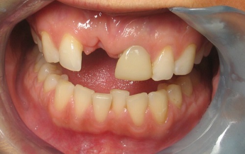 Trồng răng cửa hàm trên - Phương pháp phục hình răng hiệu quả 1