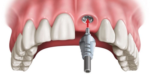 Trồng răng cửa hàm trên - Phương pháp phục hình răng hiệu quả 2