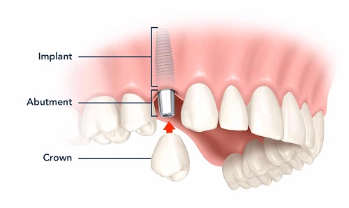 Trồng răng cửa hàm trên - Phương pháp phục hình răng hiệu quả 4