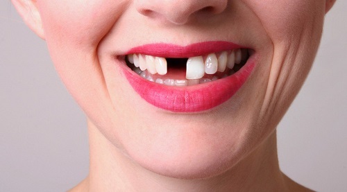Trồng răng sứ bao nhiêu một cái? Tùy thuộc vào 2 yếu tố chính nào?-1 Trồng răng sứ bao nhiêu một cái? Tùy thuộc vào 2 yếu tố chính nào?-1