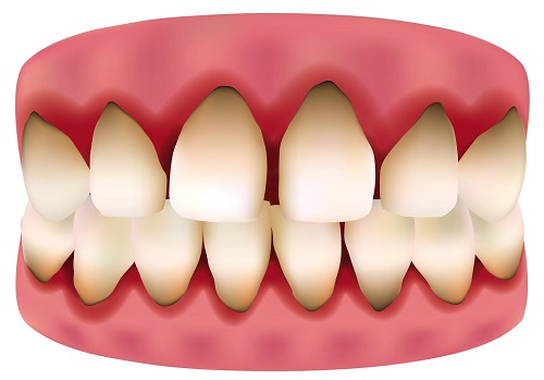 Trồng răng sứ bị đen chân răng - Do cách chăm sóc hay vật liệu trồng răng-1 Trồng răng sứ bị đen chân răng - Do cách chăm sóc hay vật liệu trồng răng-1